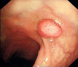 A polyp at large bowel